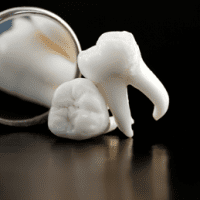 wisdom teeth